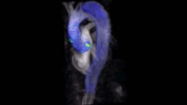 Allen uses 4D flow MRI to visualize blood flow through the heart in 3D.